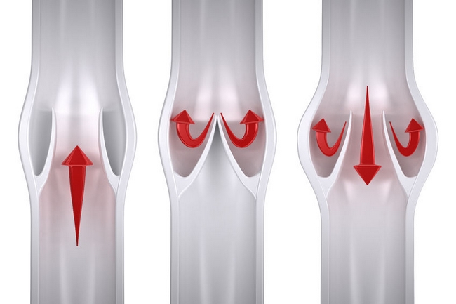 32041584 – normal vs varicose – vein anatomy